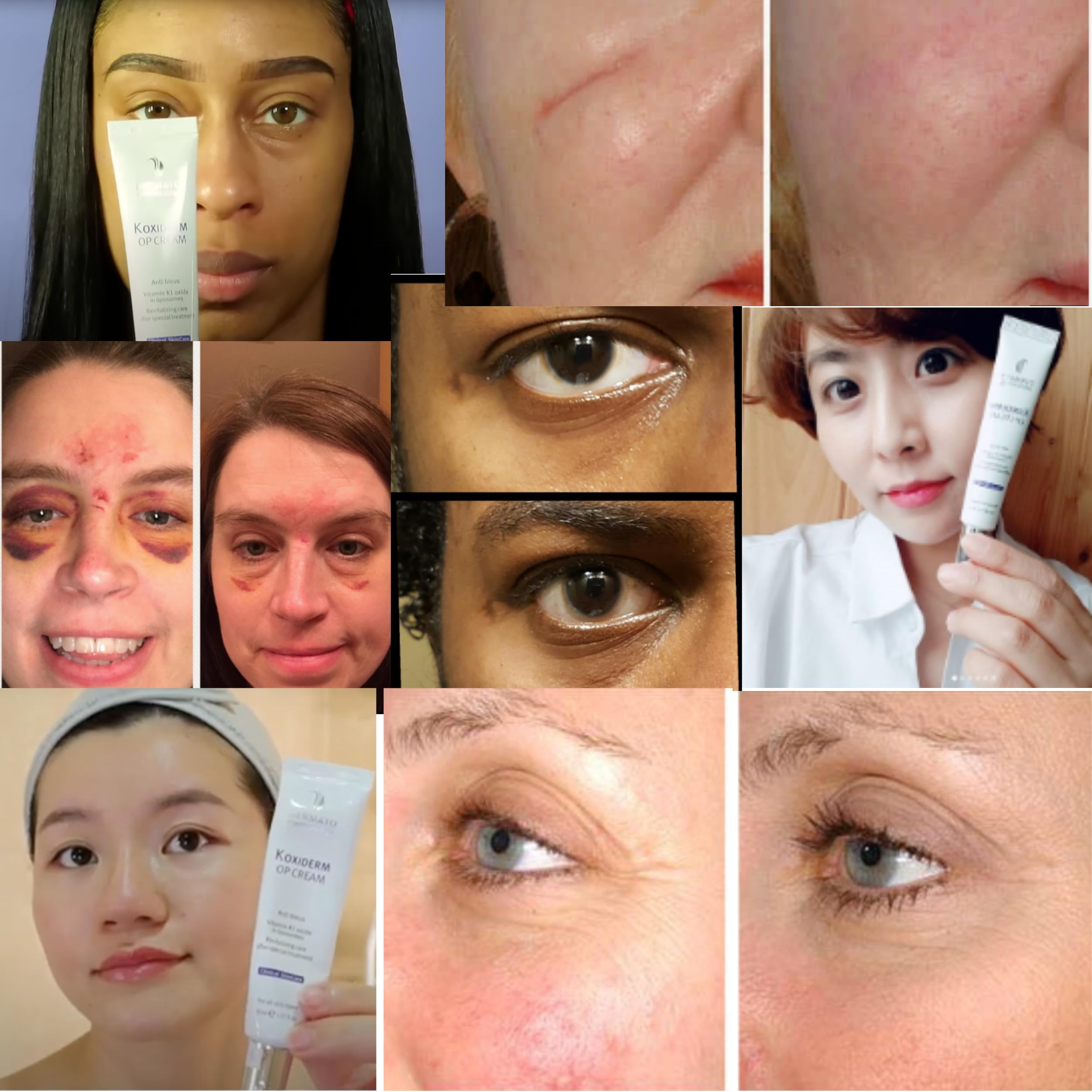 Anacis Crème Oxiderm soutient varices visibles et veines sensibles avec douceur