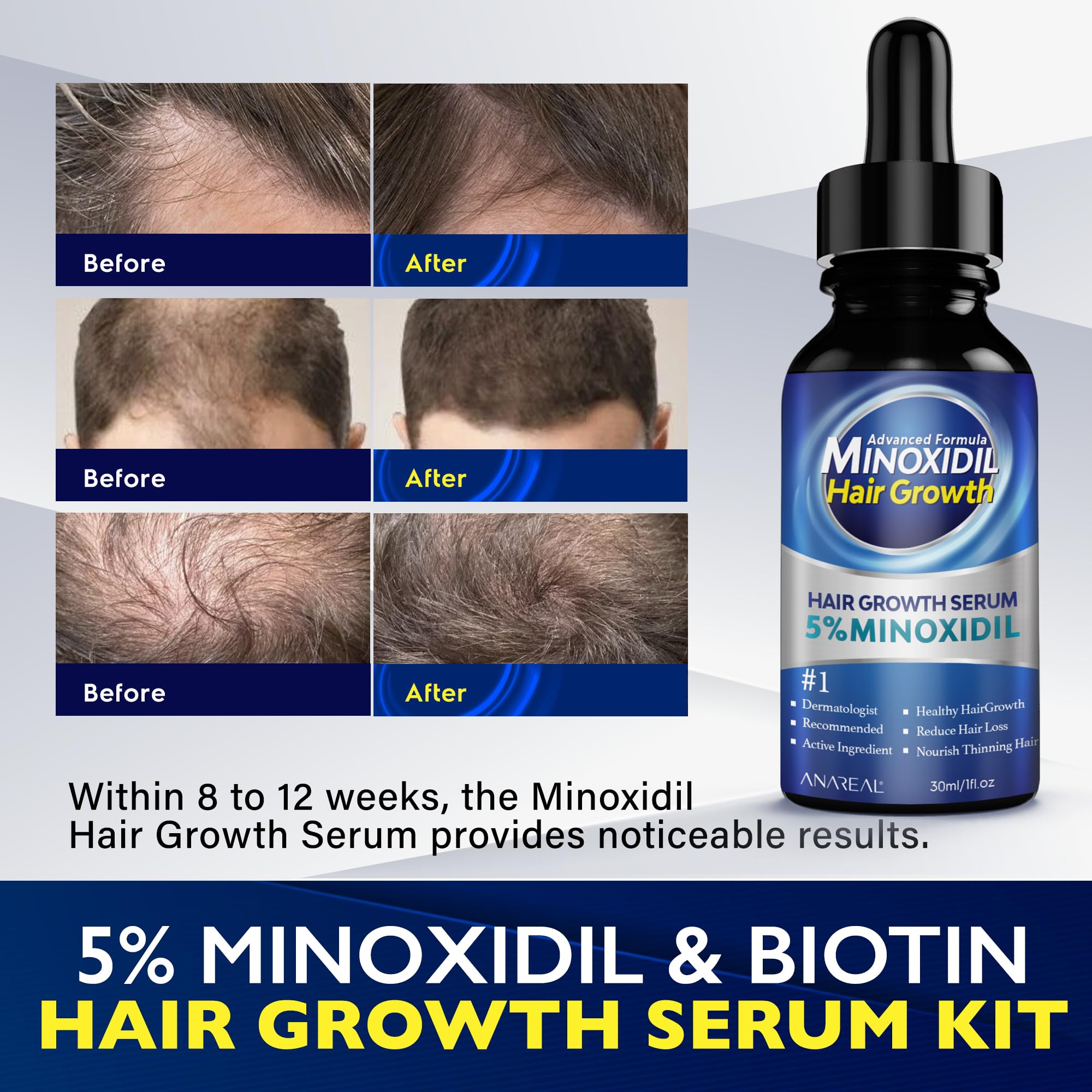 ANAREAL Minoxidil pour homme - application facile pour barbe.