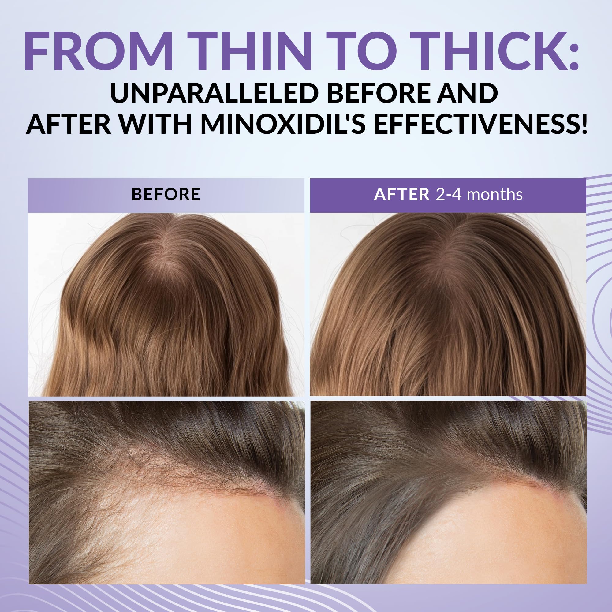 ANTROLIFE Minoxidil femme 2% vitamines et extraits naturels, soin complémentaire.