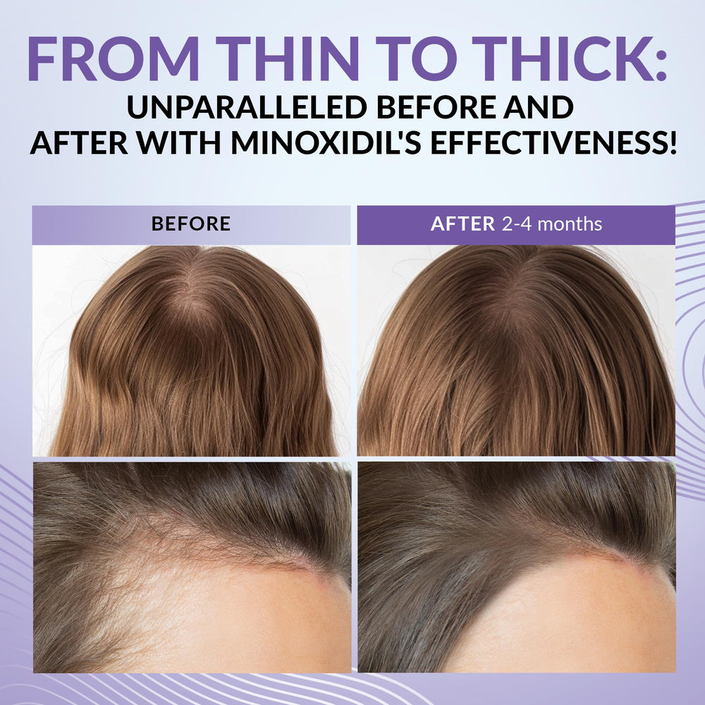 ANTROLIFE Minoxidil femme 2% vitamines et extraits naturels, soin complémentaire.