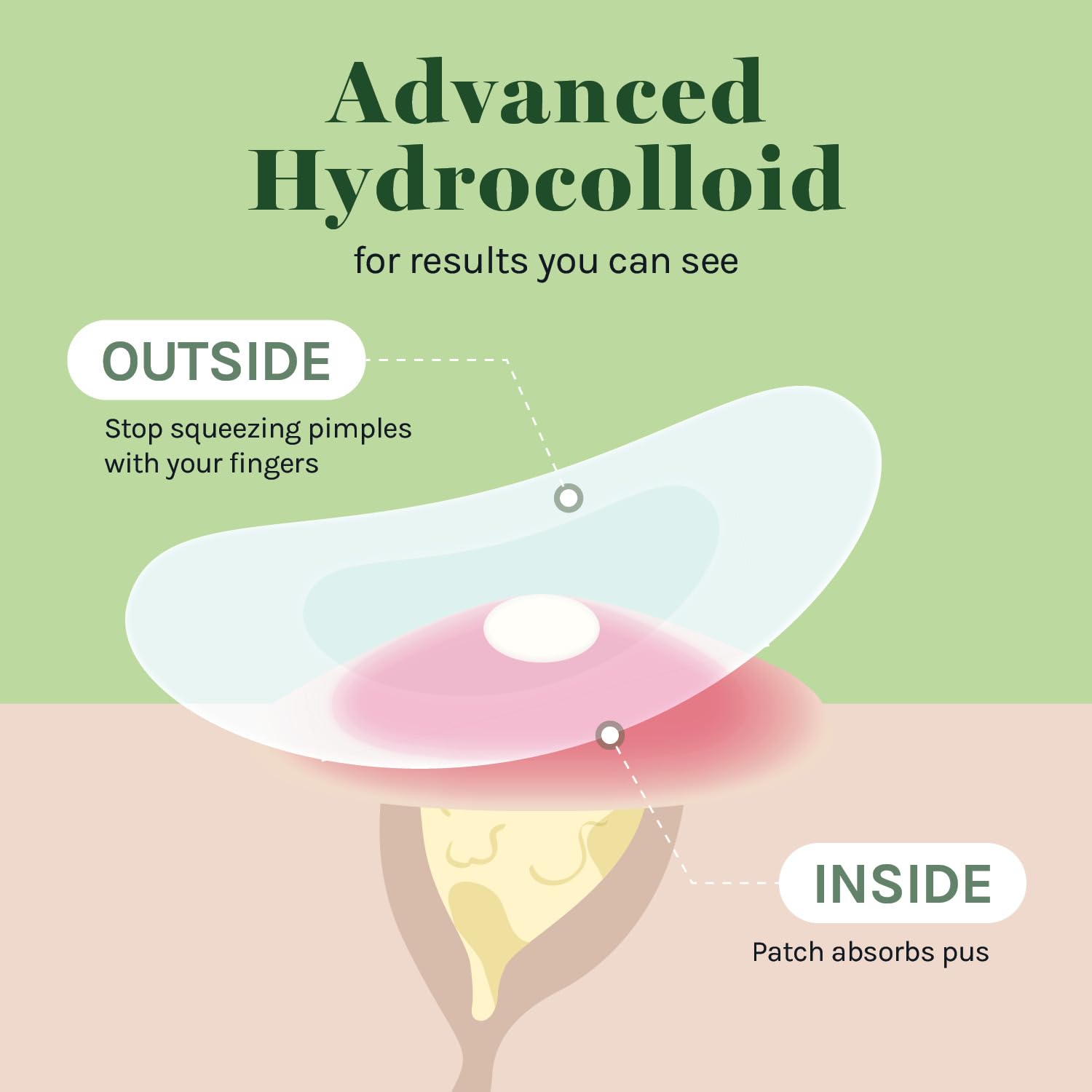 Adhérence durable du pansement hydrocolloïde AOA Studio 10 mm.