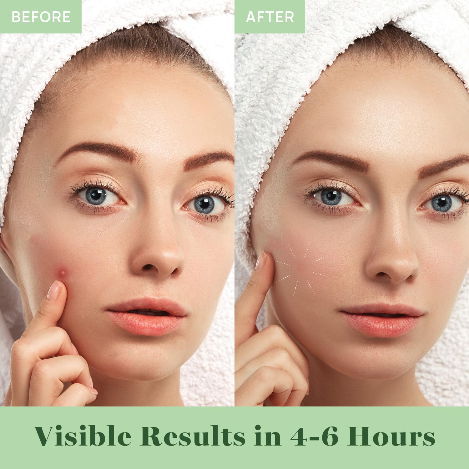 Patch hydrocolloïde AOA Studio compatible avec le maquillage.