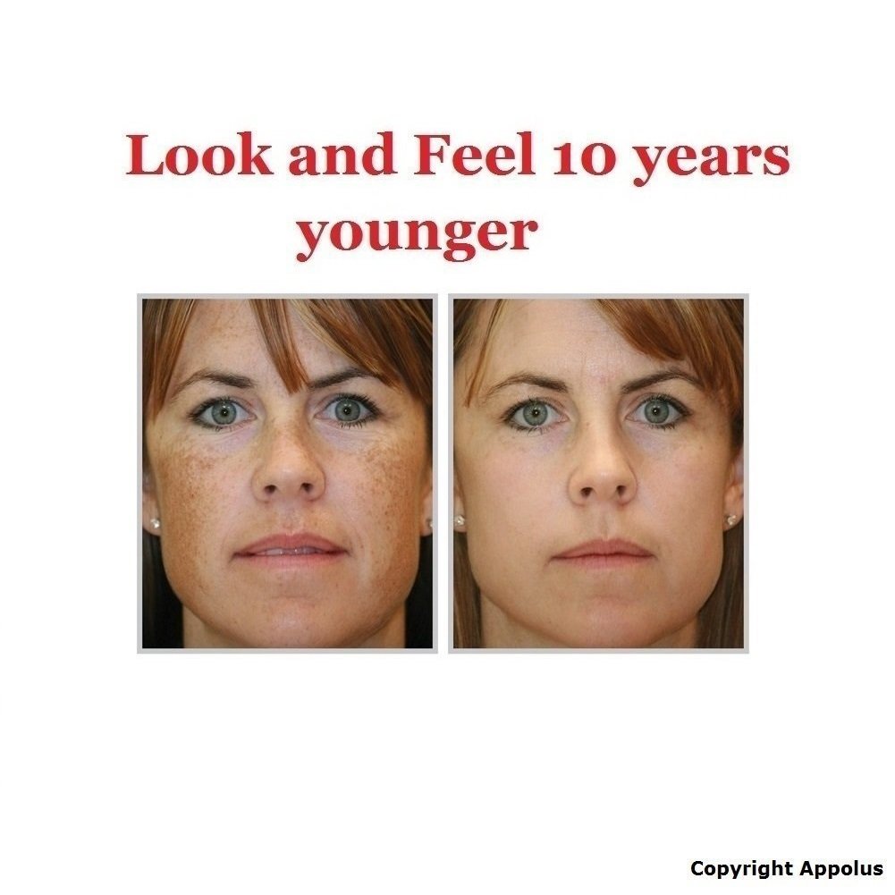 Appolus microdermabrasion kit prise en main rapide pour routine maison.