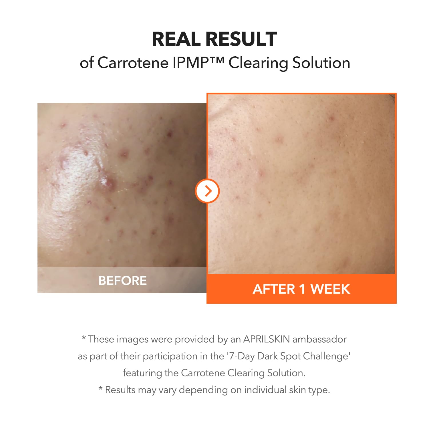 APRILSKIN Carrotene IPMP après nettoyage et tonique, application sur tout le visage.