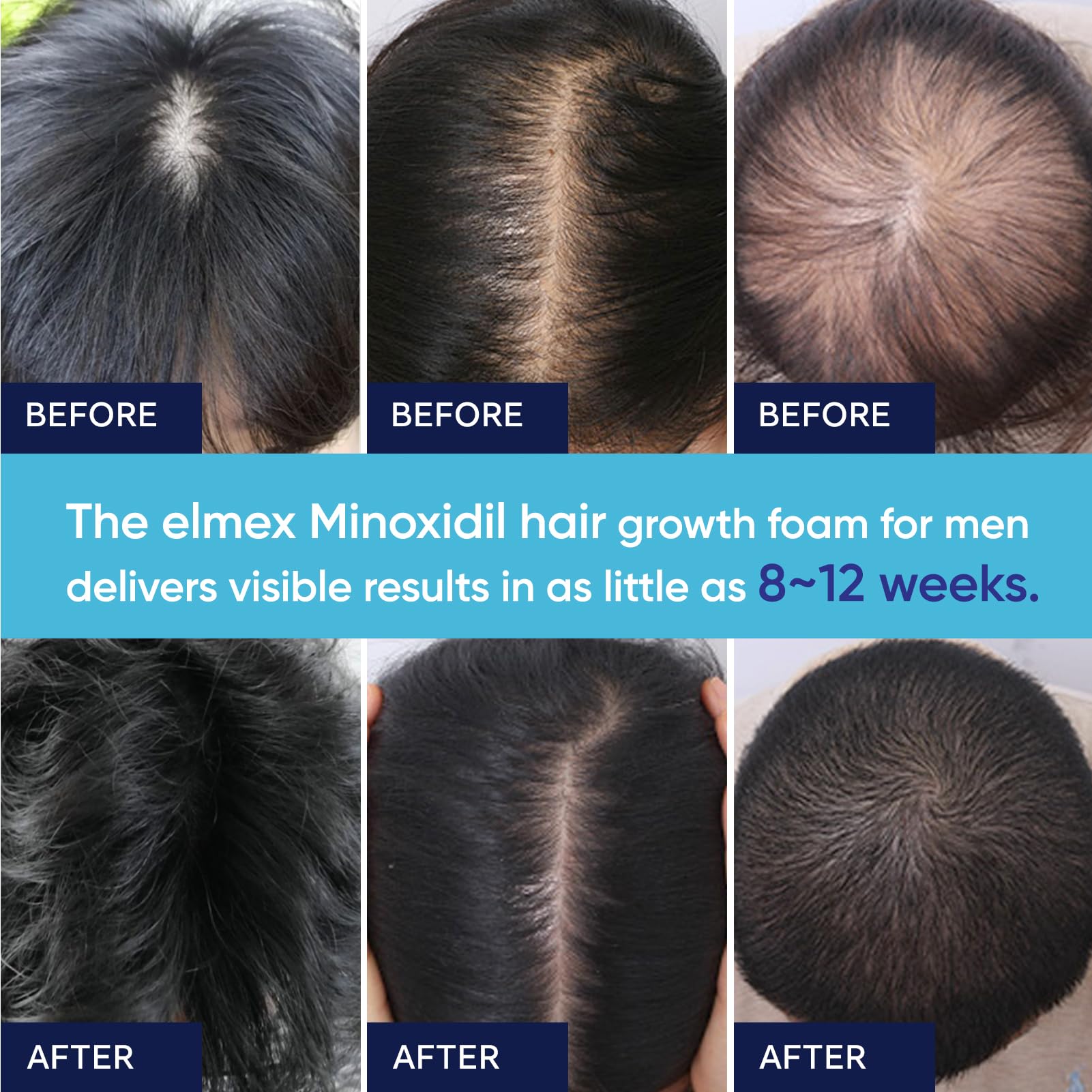 Conditionnement pratique et clair d’Artimore Minoxidil Mousse