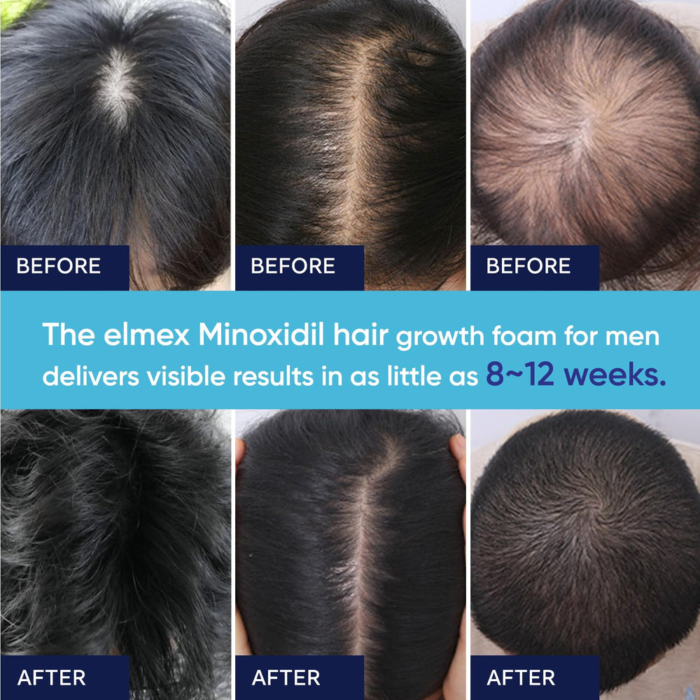 Conditionnement pratique et clair d’Artimore Minoxidil Mousse