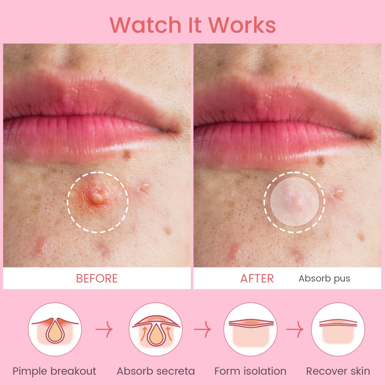 Patch AUSLKA anti-boutons visage 12 mm, adapté aux imperfections plus grandes.