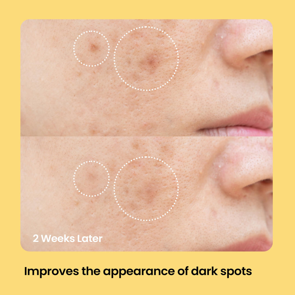 AVARELLE patch taches sur le visage en action, ciblant les zones concernées.
