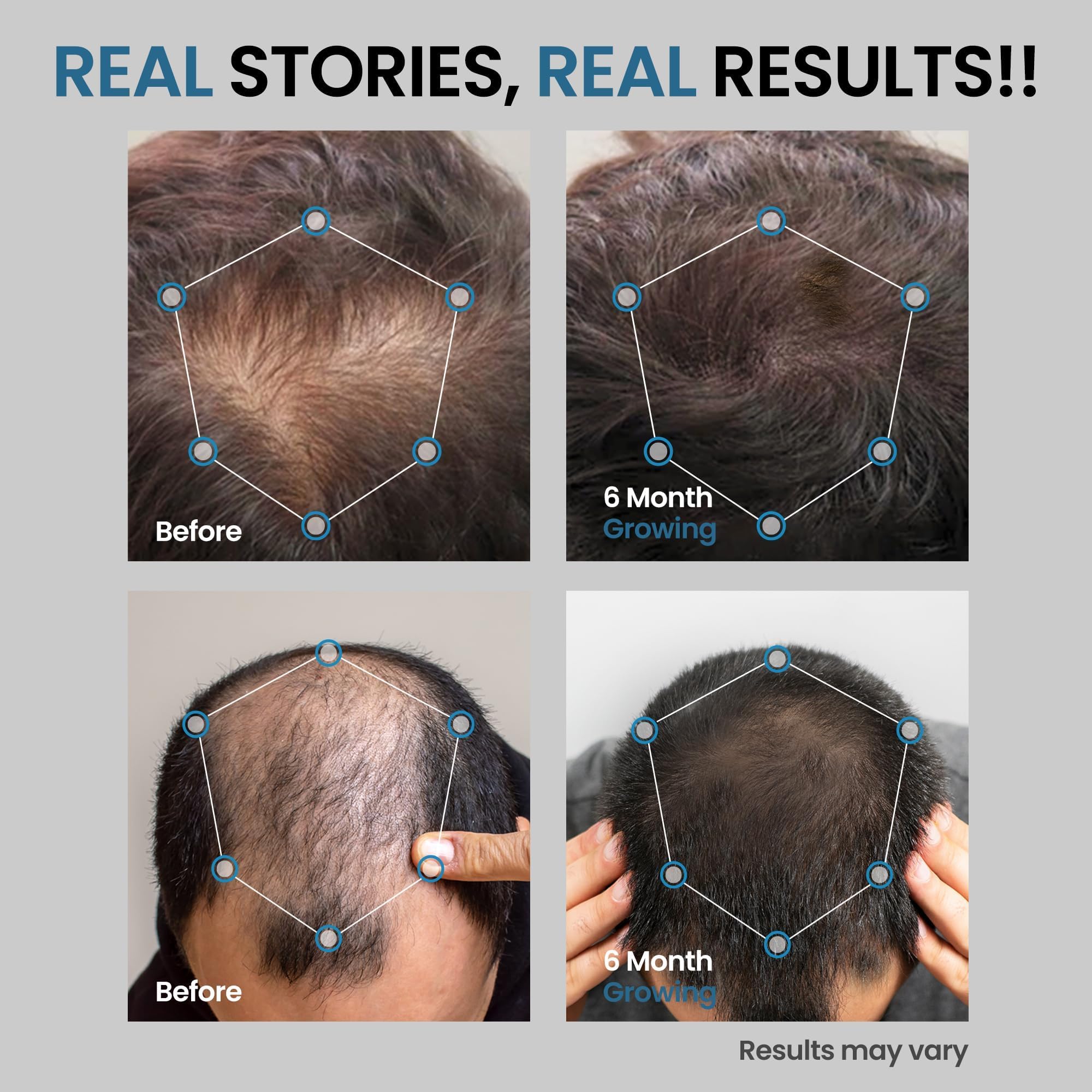 AVITAPURE Minoxidil – formulation douce avec glycérine pour confort