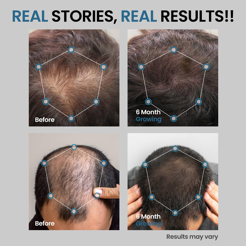 AVITAPURE Minoxidil – formulation douce avec glycérine pour confort