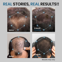 AVITAPURE Minoxidil – formulation douce avec glycérine pour confort