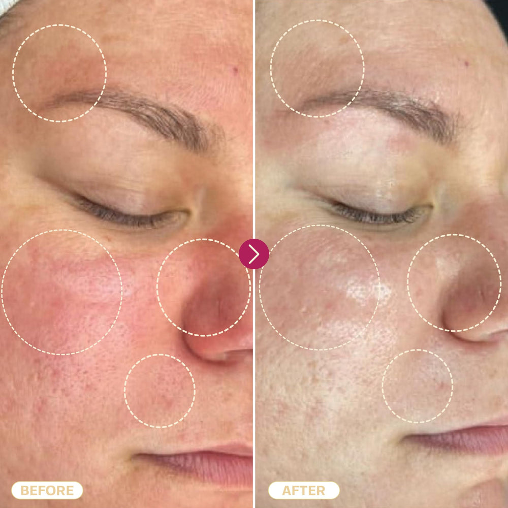 BASE LABORATORIES Hypochloreux spray – aide potentielle pour l'acné et les imperfections