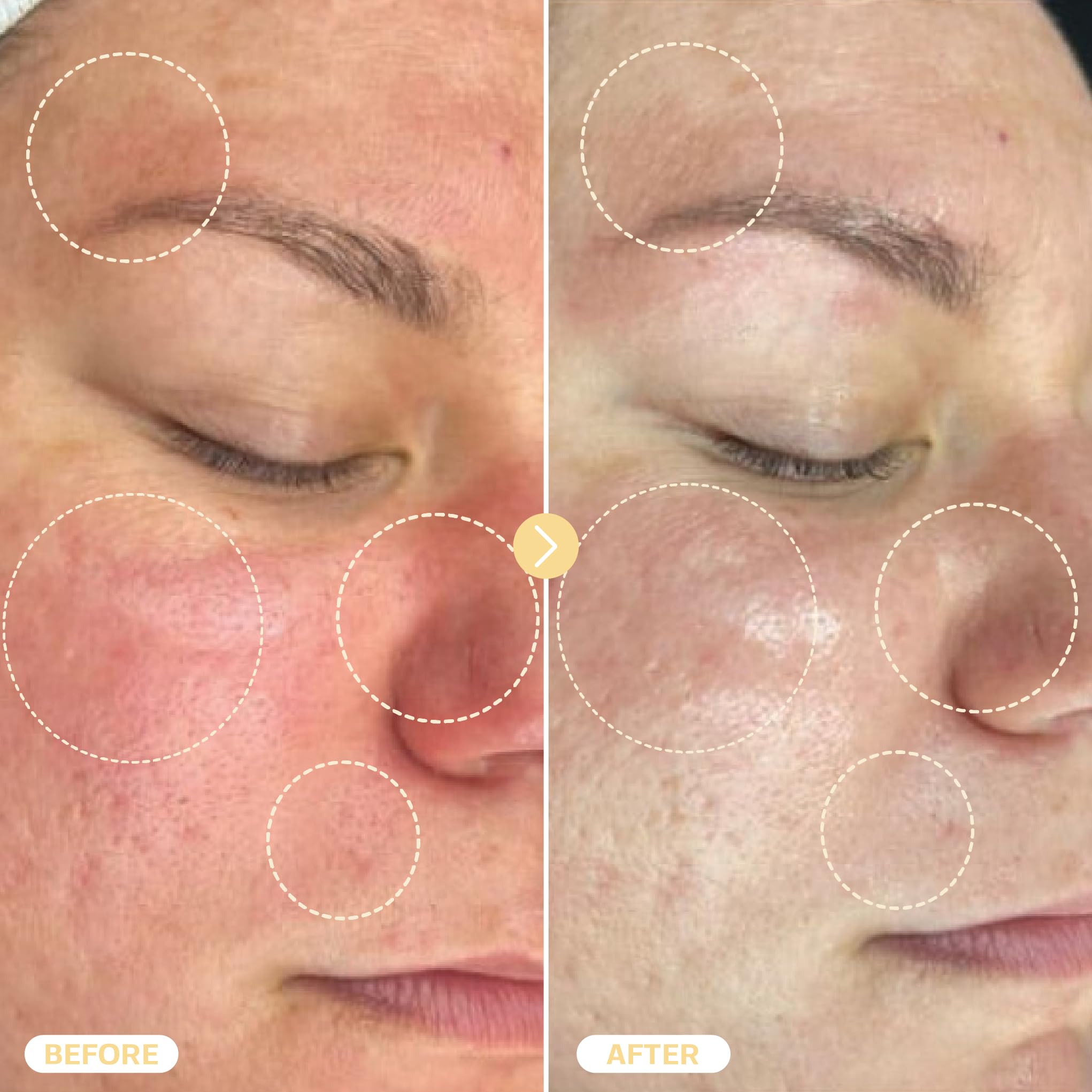 BASE LABORATORIES Hypochloreux soin acné visage – aide à réduire les imperfections.