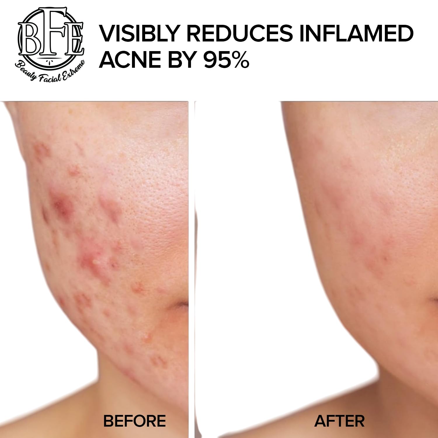 Beauty Facial Extreme – acide salicylique et acides alpha-hydroxylés pour l’équilibre cutané