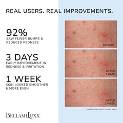 BellamiLuxx Lotion folliculite corps, peau plus lisse après application.