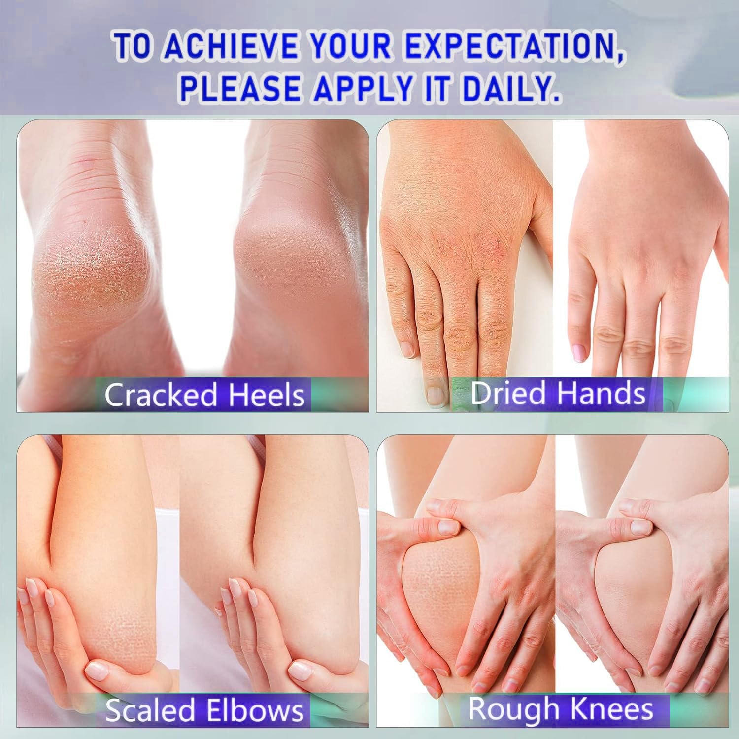 Pieds plus confortables avec Berveal 42% urea et acide salicylique 2%
