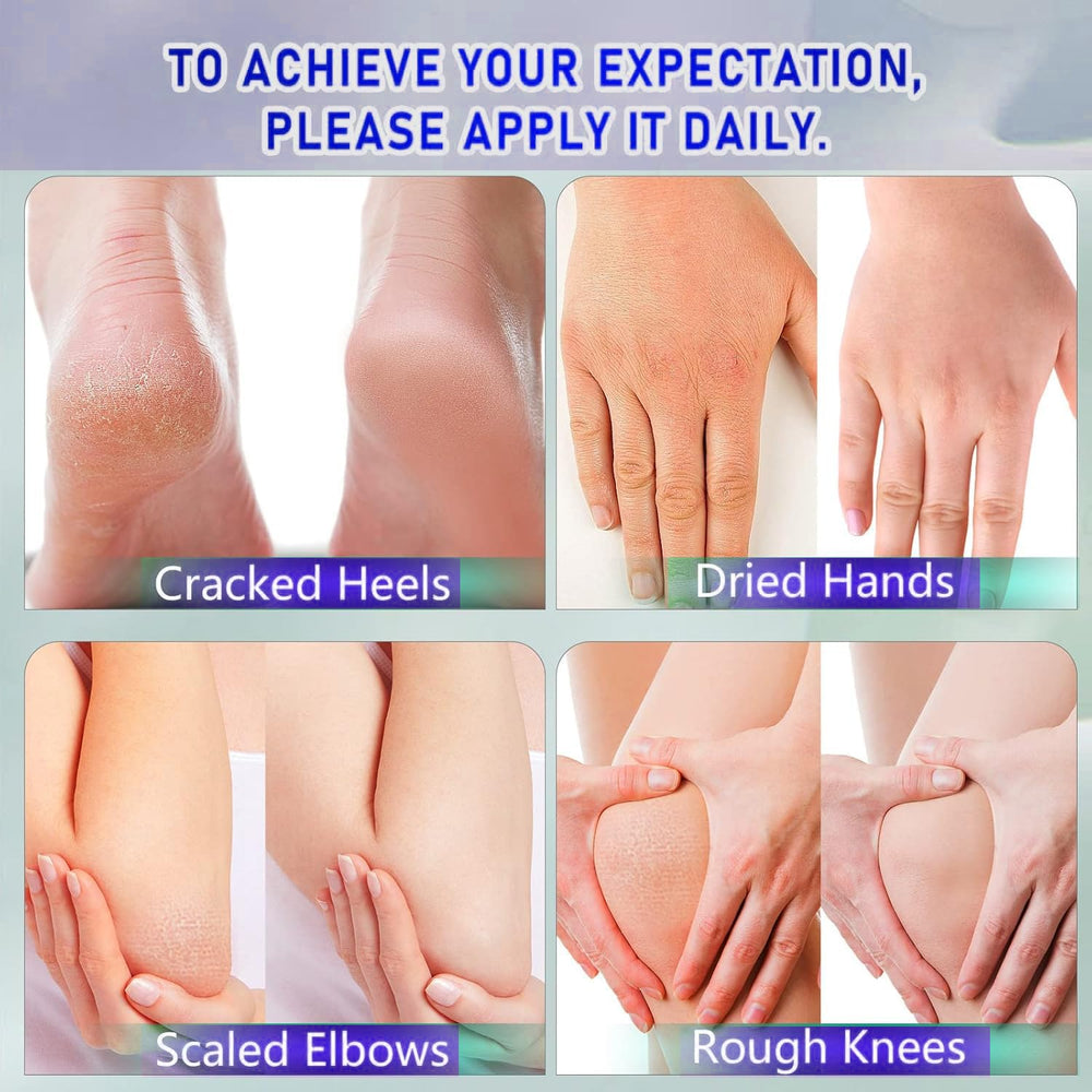 Pieds plus confortables avec Berveal 42% urea et acide salicylique 2%