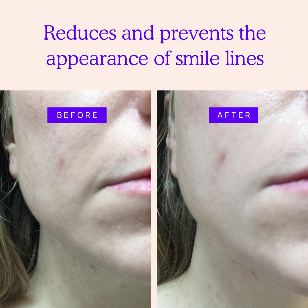 Bandes BLUMBODY anti-rides pour les lignes entre les yeux, regard plus lisse.