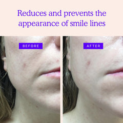 Bandes BLUMBODY anti-rides pour les lignes entre les yeux, regard plus lisse.