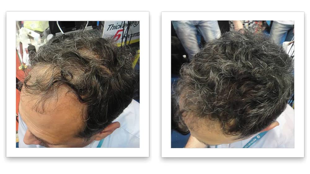Caboki: apparence densifiée après application sur cheveux clairsemés