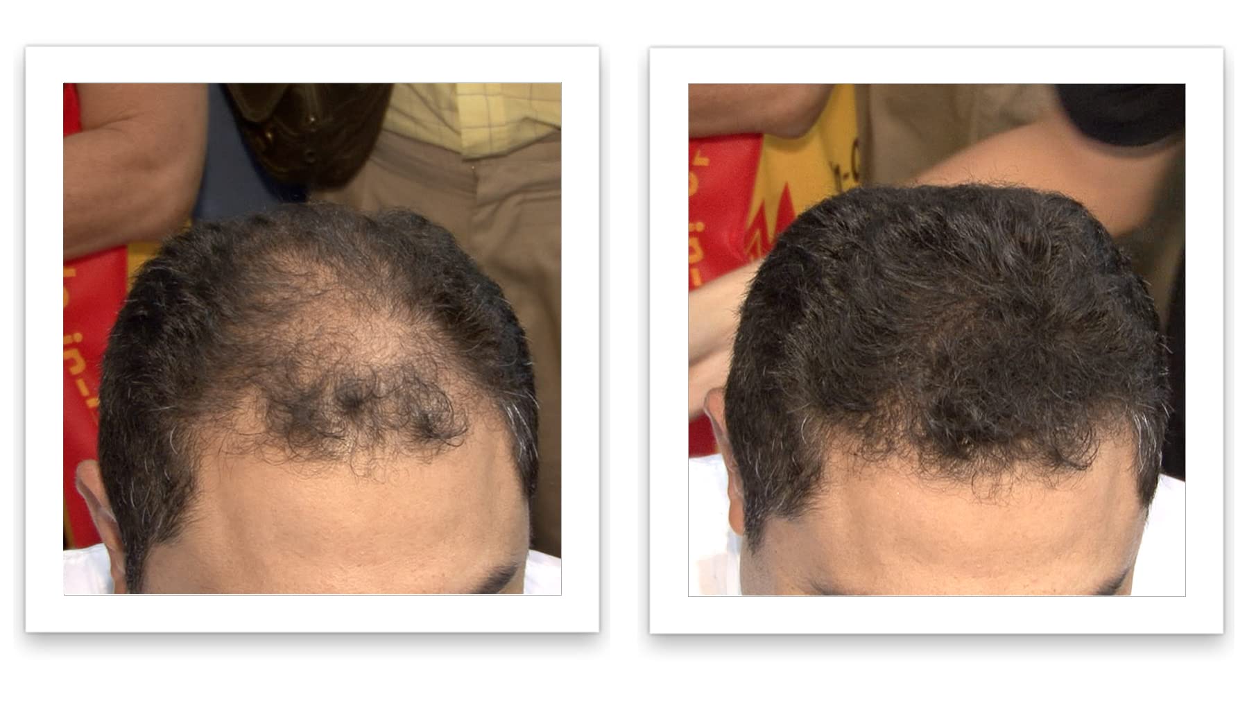 Caboki effet 10x plus dense sur cheveux clairsemés pour un look naturel.