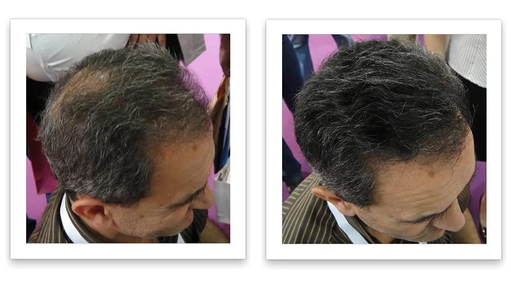 Caboki couleur Salt & Pepper-Dark adaptée aux cheveux gris et foncés