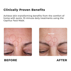 Capillus Masque lumière rose sur le visage pour un teint lumineux