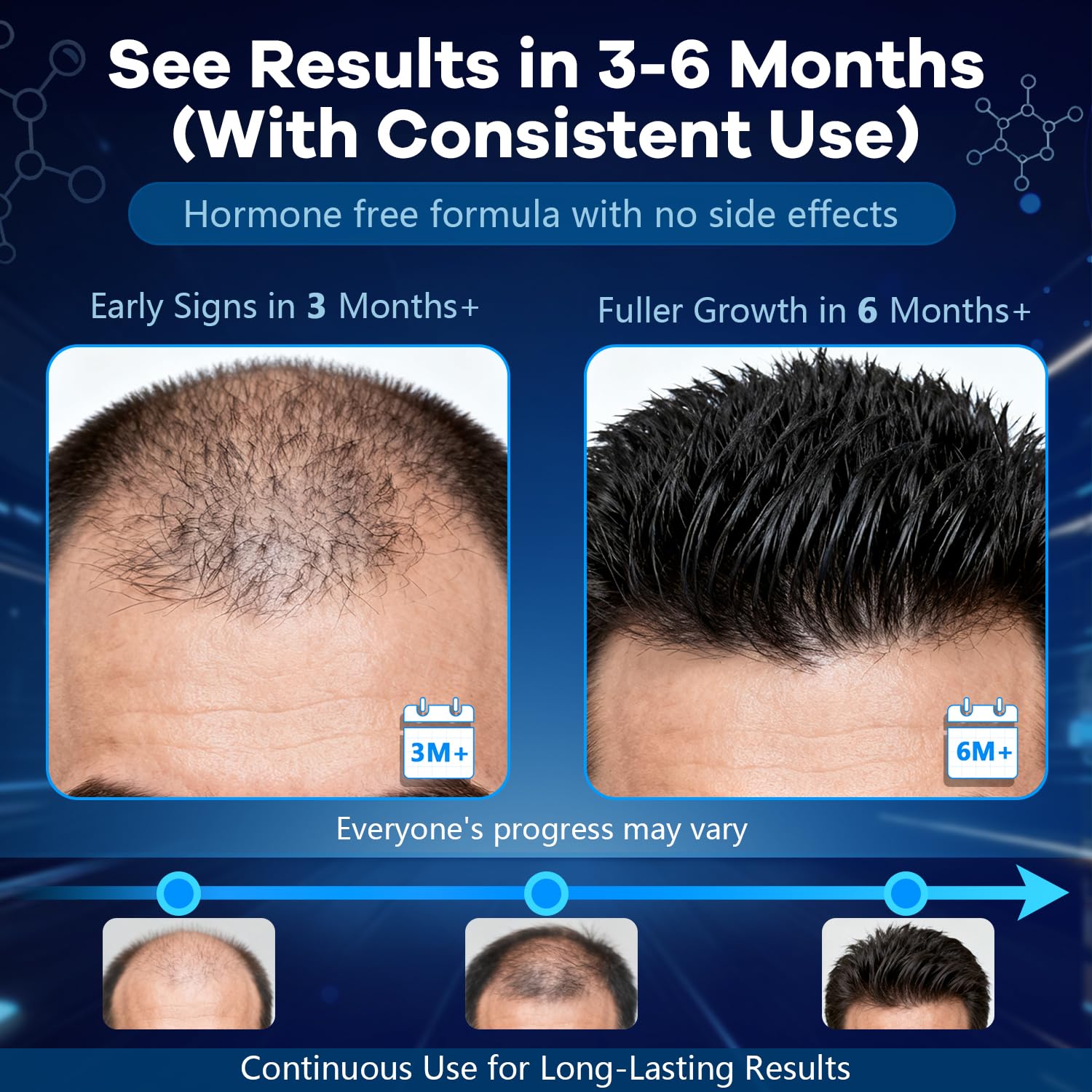 CARENICE Minoxidil Mousse soin barbe densité éventuelle