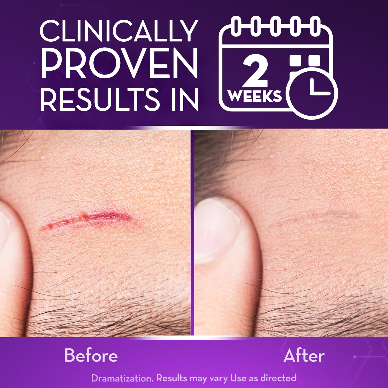 Cicatricure Gel Avancé pour cicatrices chirurgicales, amélioration potentielle avec utilisation régulière.