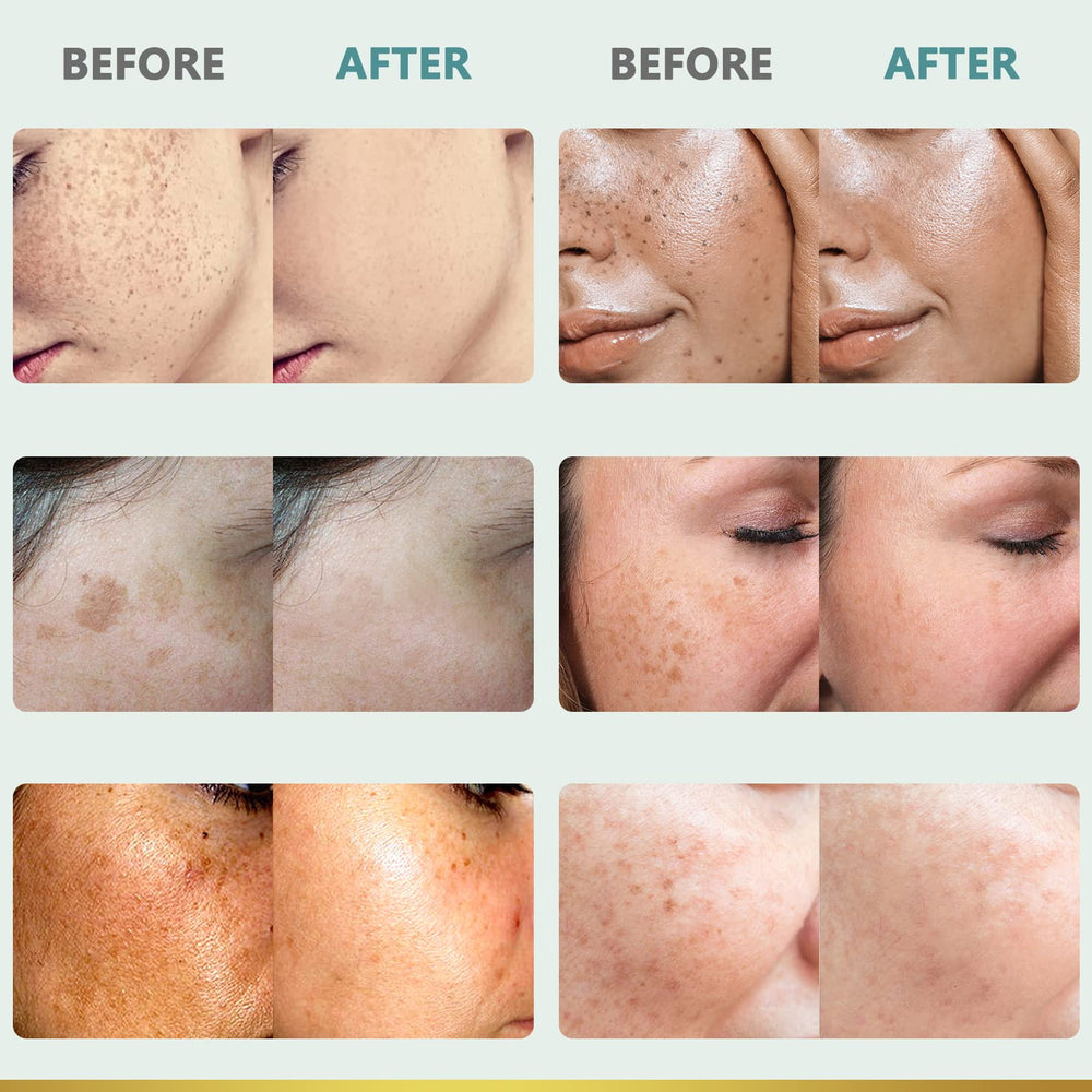 CITYGOO Dark Spot Remover – Avant/après montrant un teint plus clair et lumineux