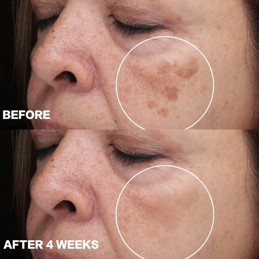 CITYGOO Dark Spot Remover – Extraits de Gentian Scabra pour soutenir la correction du teint