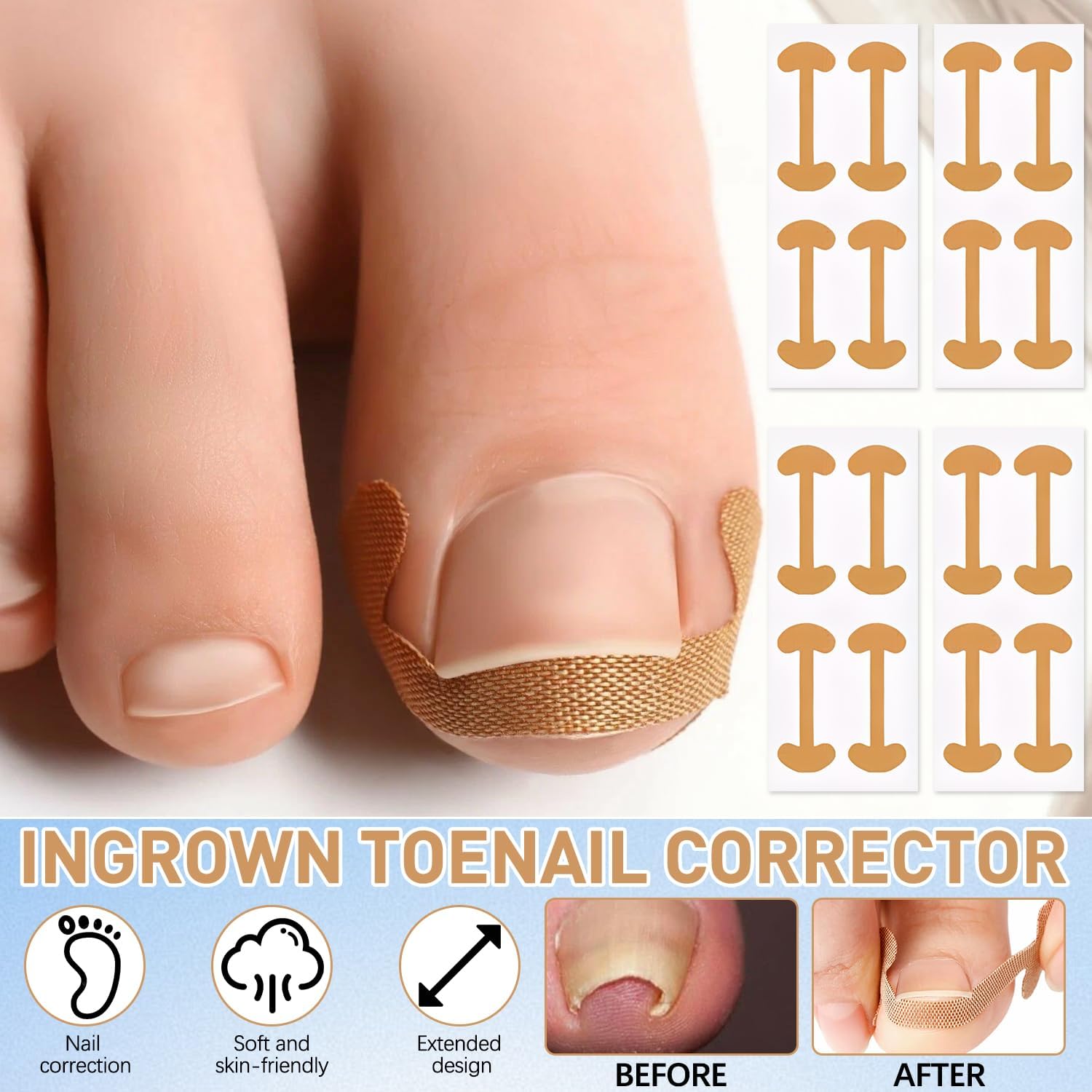 Correcteur d’ongle incarné – courbure-adaptee : adhérence adaptée à la courbure naturelle.
