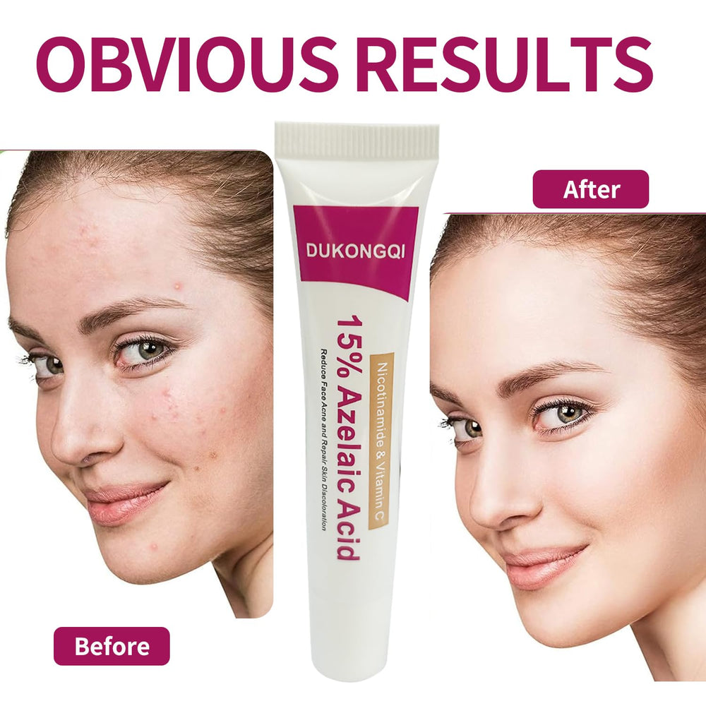 Crème acide azélaïque visage, application facile pour teint uniforme
