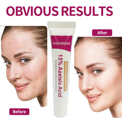 Crème acide azélaïque visage, application facile pour teint uniforme