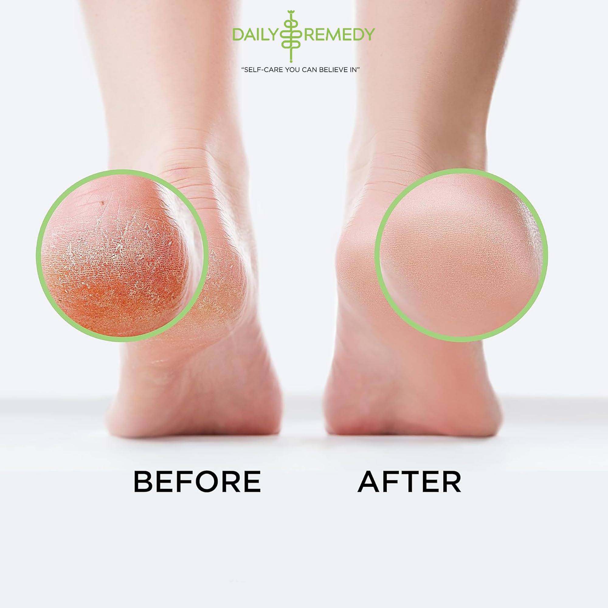 Daily Remedy formule sans agressifs, soin doux pour la peau des pieds.
