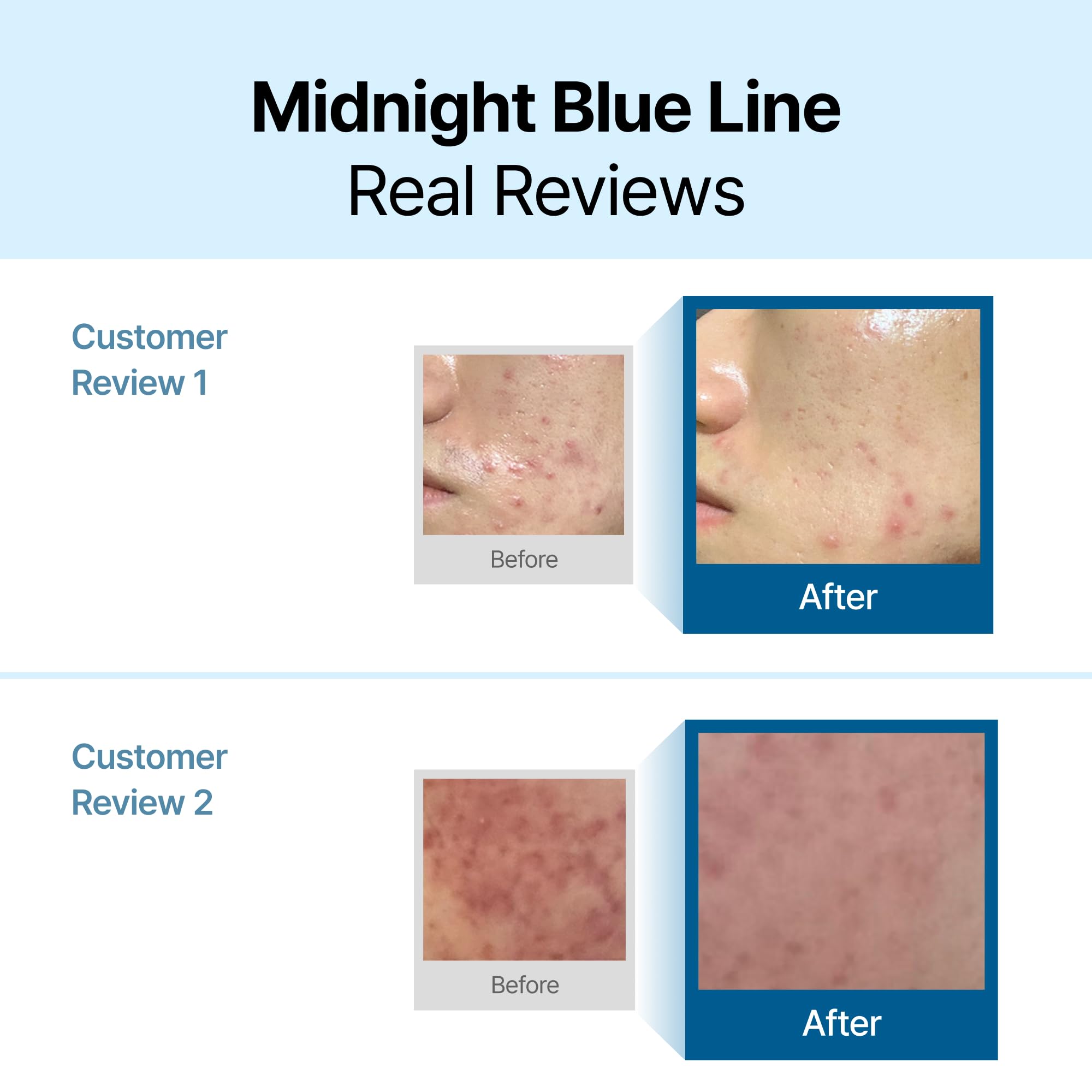Application douce de DearKlairs Midnight Blue Calming Cream après irritation
