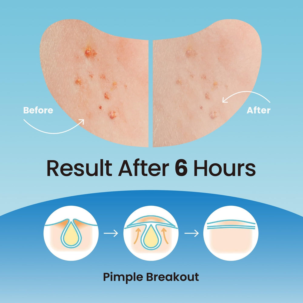 Patch hydrocolloïde DERMA ANGEL sur front, traitement discret des imperfections.