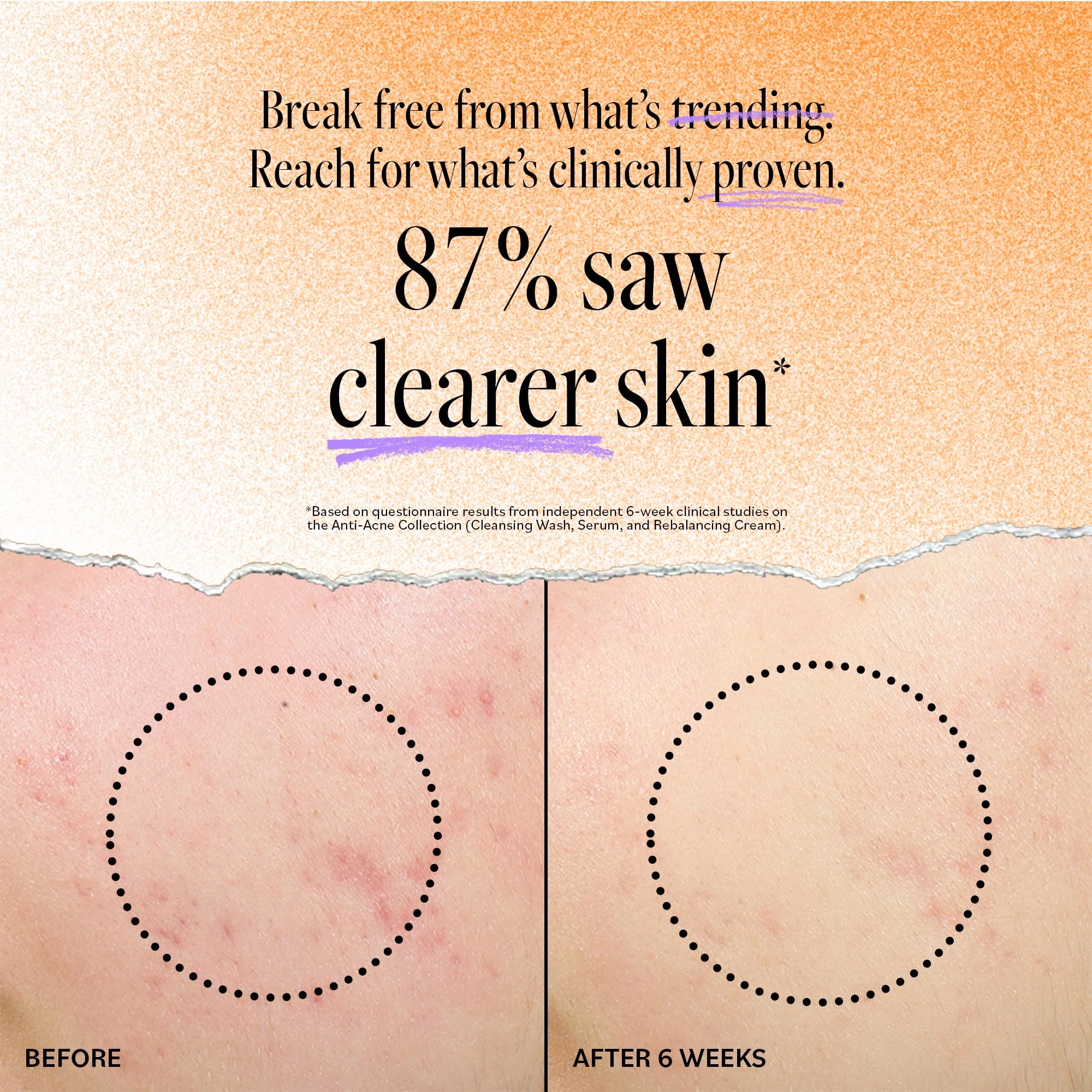 Derma E Acne Deep Pore Wash ingredients panel with tea tree and salicylic acid benefits.