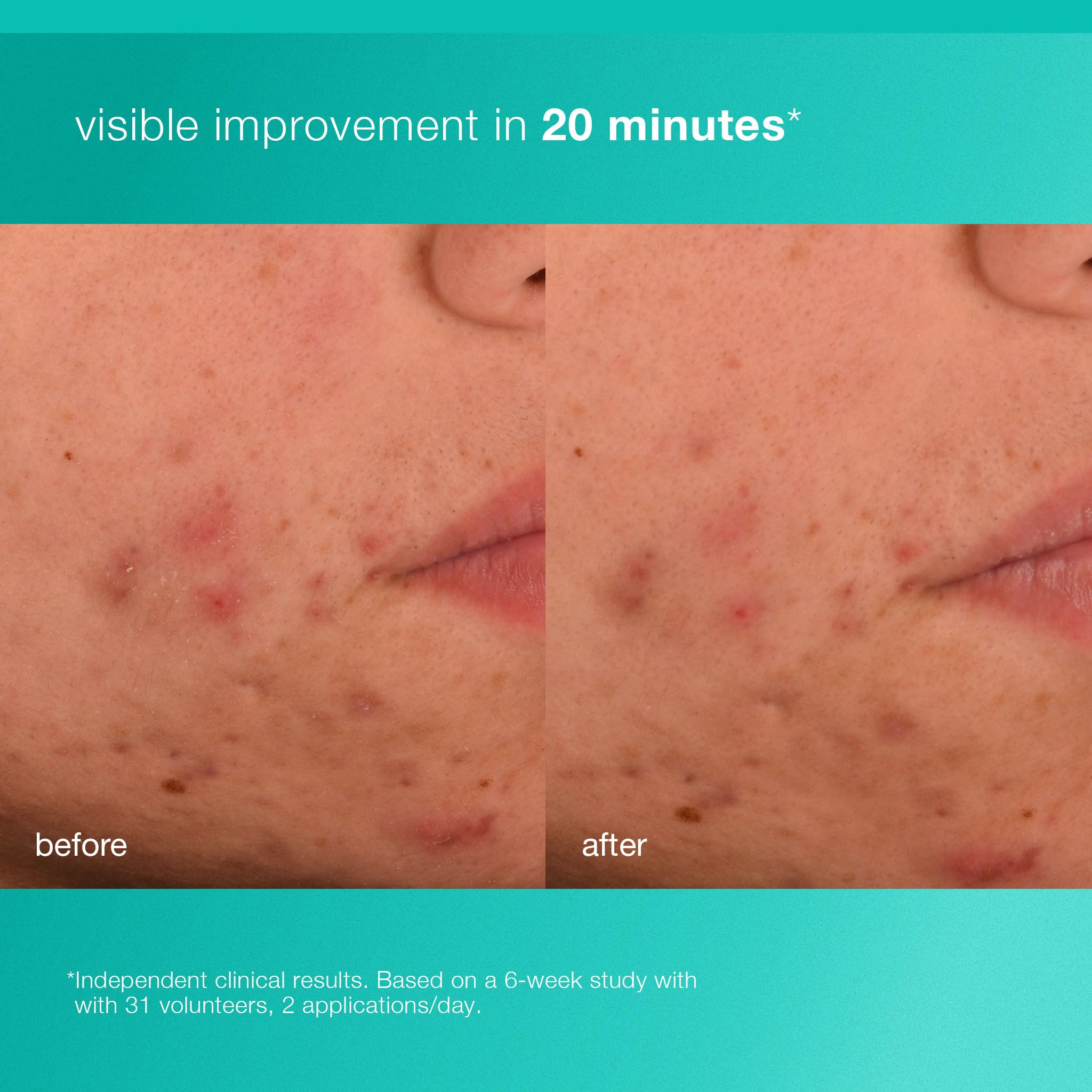 Dermalogica Acne Biotic – niacinamide et jojoba pour lisser la peau