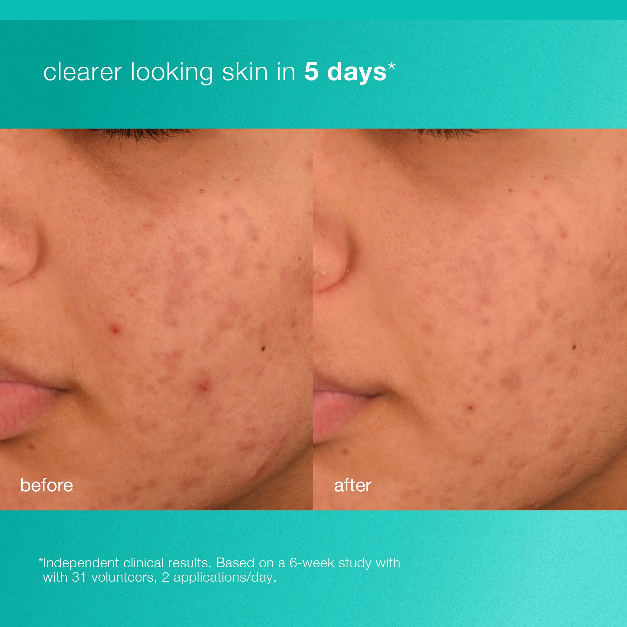 Dermalogica Acne Biotic – salicylique 0,5 % cible les imperfections