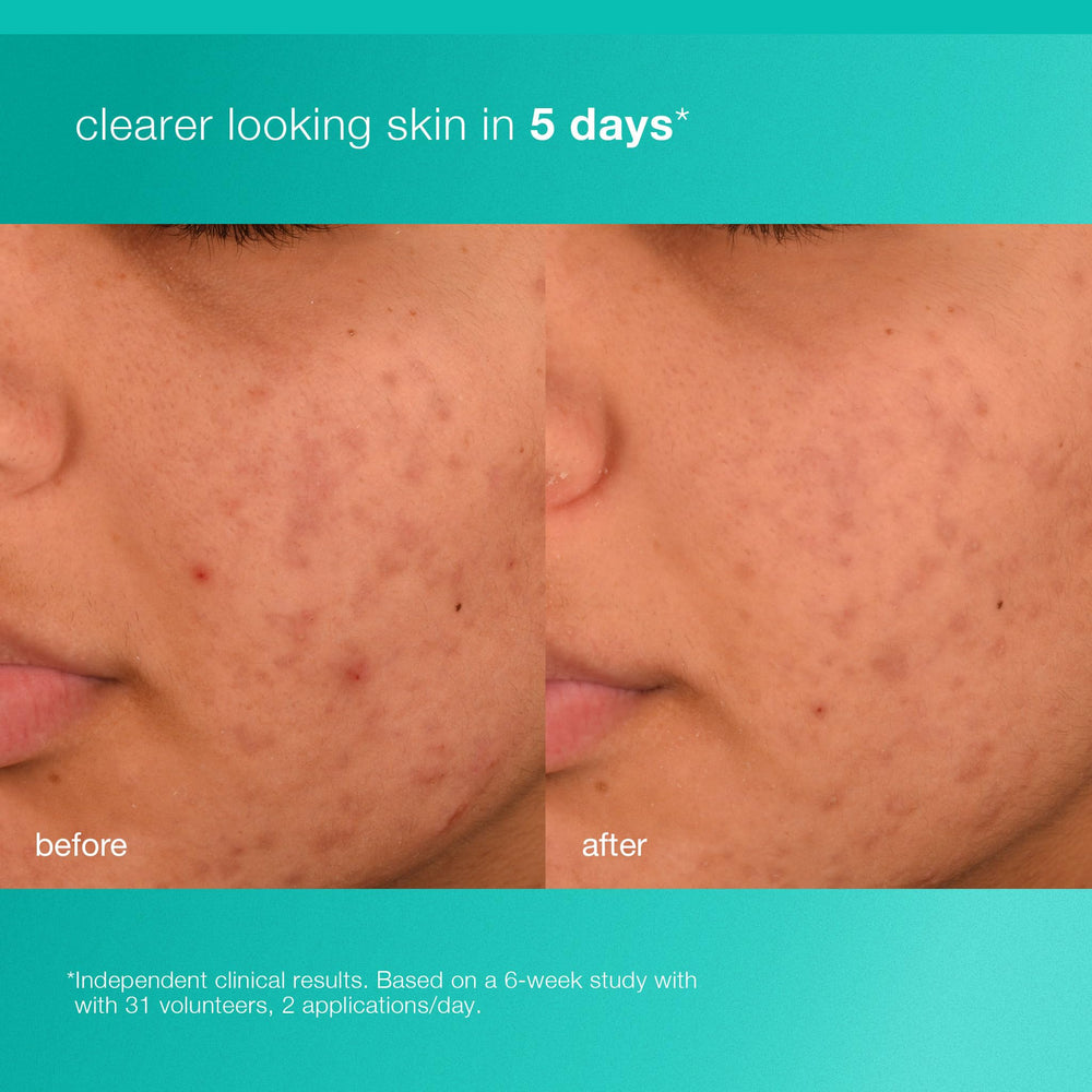 Dermalogica Acne Biotic – salicylique 0,5 % cible les imperfections