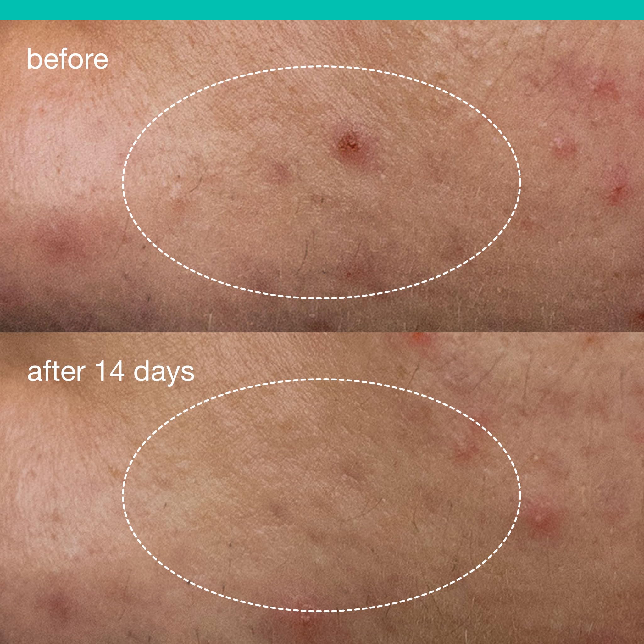 Niacinamide dans Dermalogica Deep Acne Patch équilibre la peau
