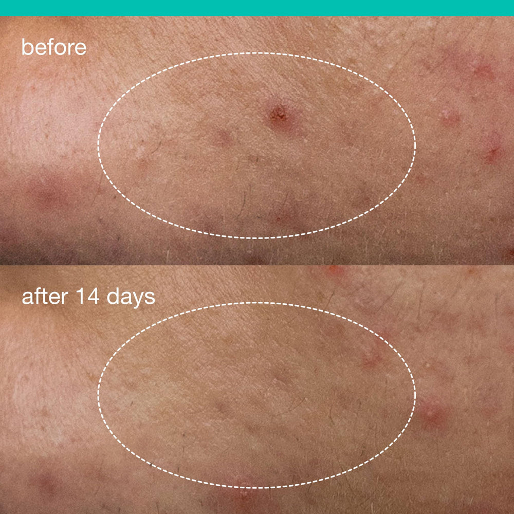 Niacinamide dans Dermalogica Deep Acne Patch équilibre la peau