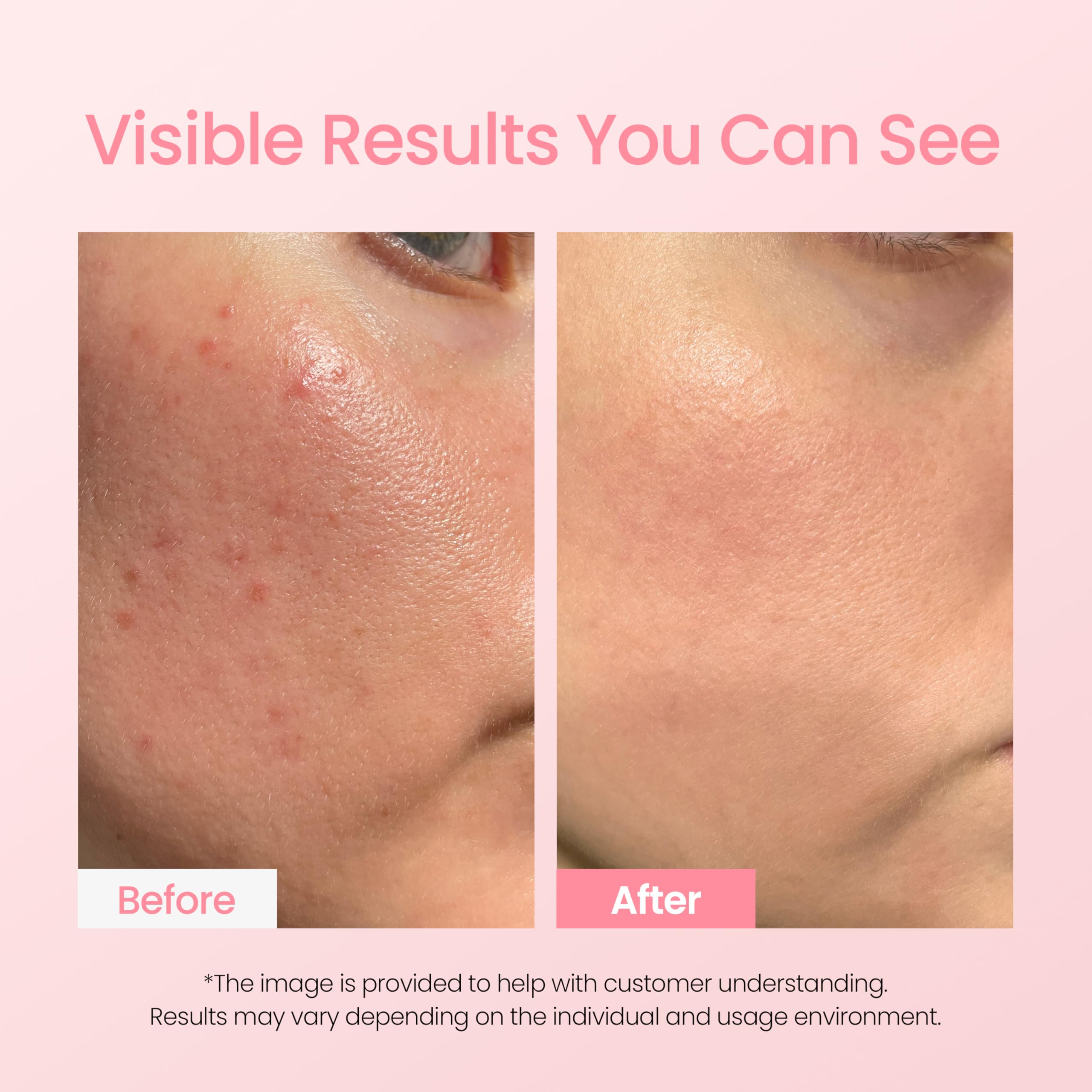 Dermalogy A-Clear: application nocturne ciblée pour le visage.