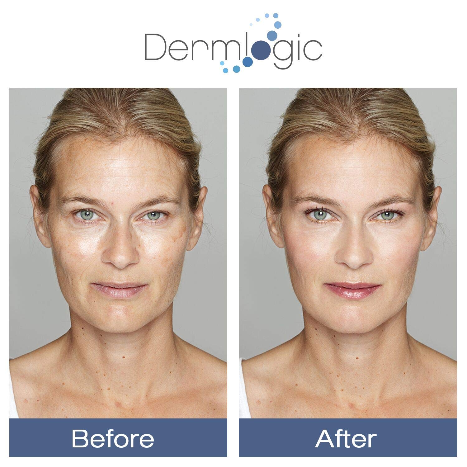 Avant-après Glycolique 15% Dermlogic – comparaison du teint
