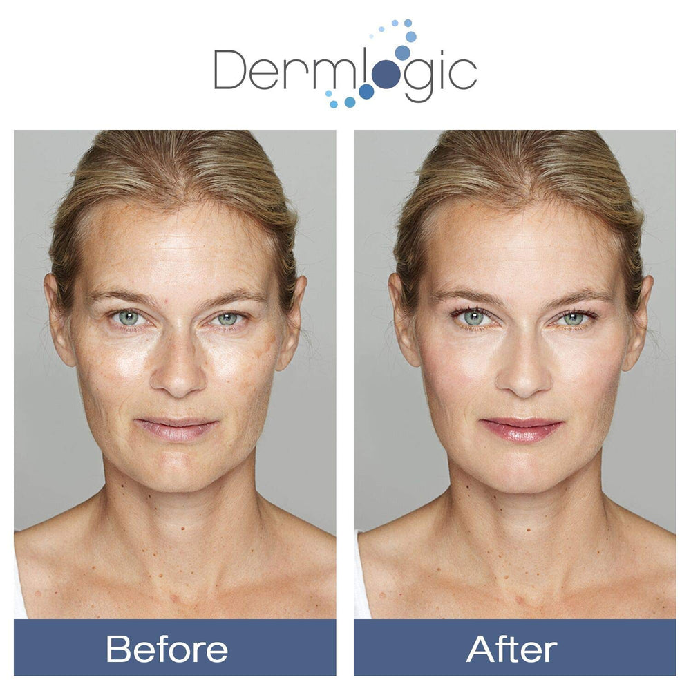Avant-après Glycolique 15% Dermlogic – comparaison du teint