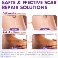 DFK bandes silicone cicatrice ergonomiques épousent la forme de la cicatrice pour une utilisation discrète.