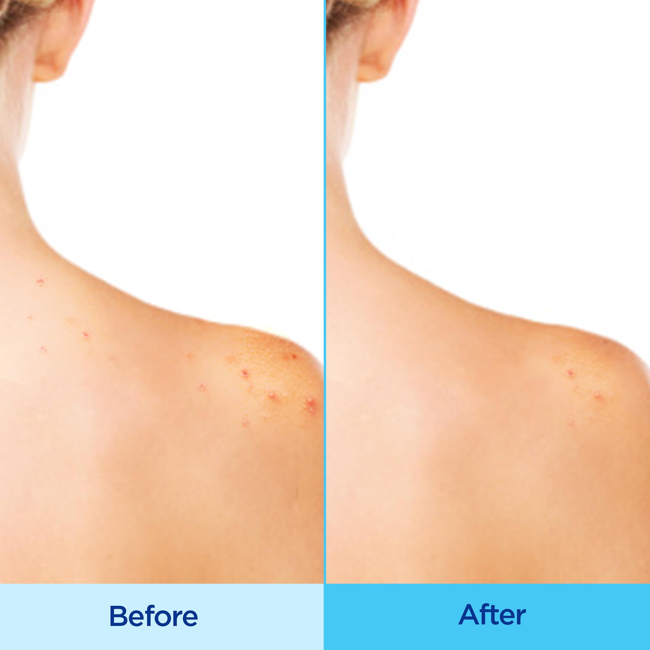 Differin Spray Corps présente 3% d’acide glycolique pour exfolier en douceur.