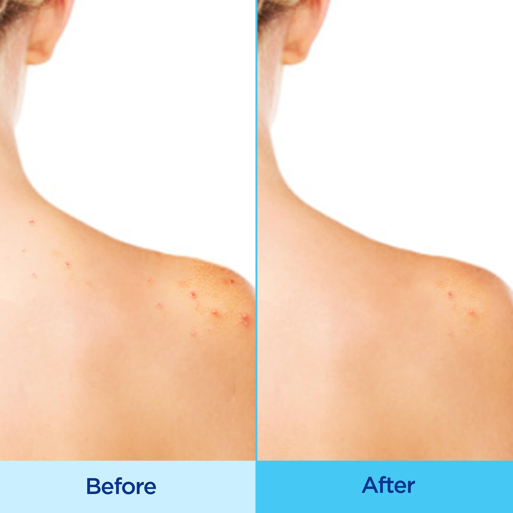 Differin Spray Corps présente 3% d’acide glycolique pour exfolier en douceur.