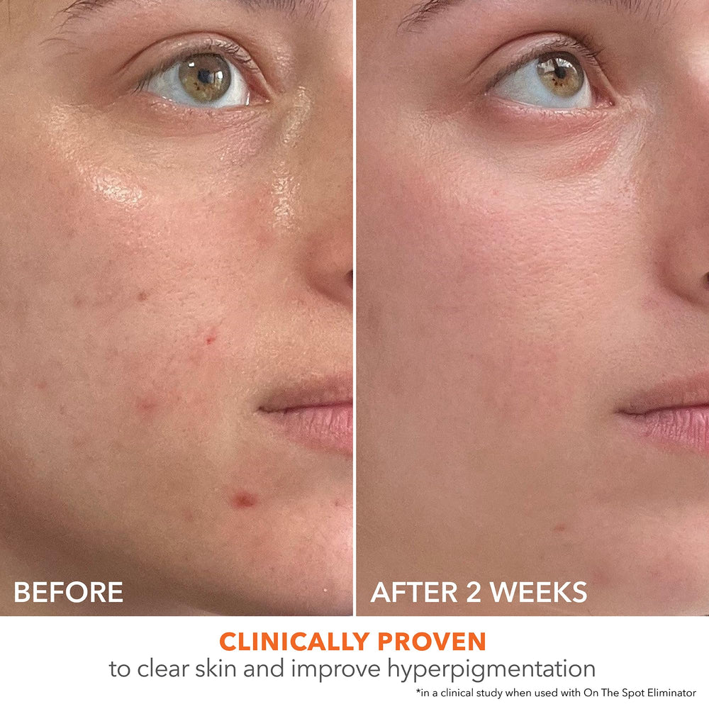 Zoom sur les pores et congestions avant/après l'utilisation.